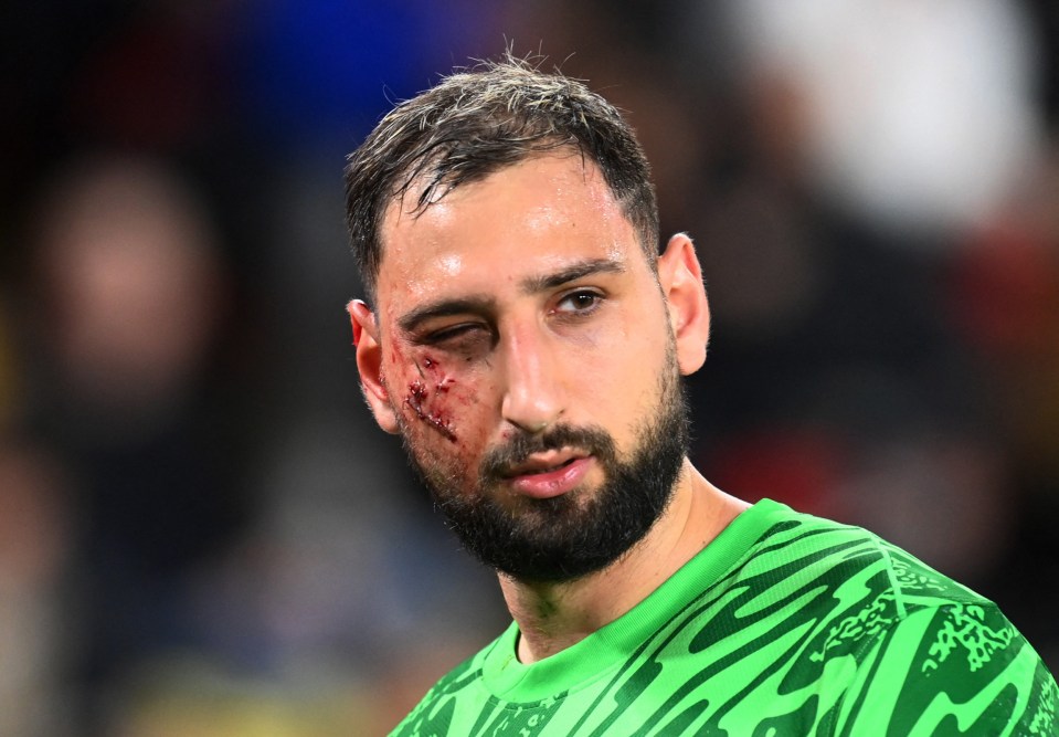 Gianluigi Donnarumma ficou com um ferimento aberto na bochecha durante o jogo de quarta-feira contra o Mônaco